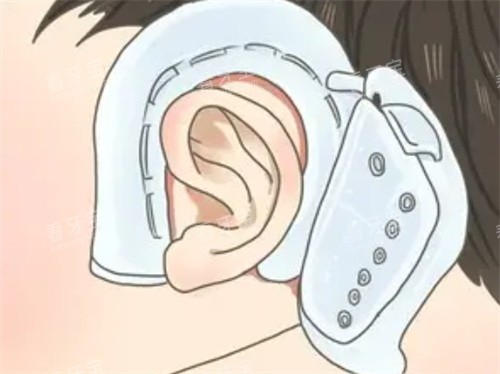 耳朵矫正器的形状.jpg 耳朵矫正器的形状.jpg