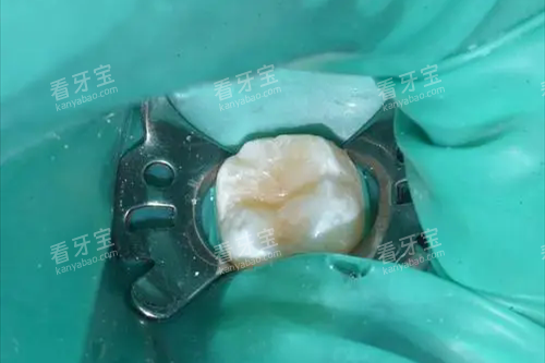 补牙橡皮障.webp.png 补牙橡皮障.webp.png