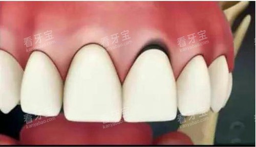 烤瓷牙基牙黑线.jpg 烤瓷牙基牙黑线.jpg