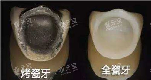 烤瓷牙和全瓷牙展示图.jpg 烤瓷牙和全瓷牙展示图.jpg