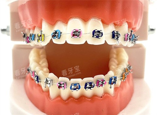 金属托槽矫正模型图片.jpg 金属托槽矫正模型图片.jpg