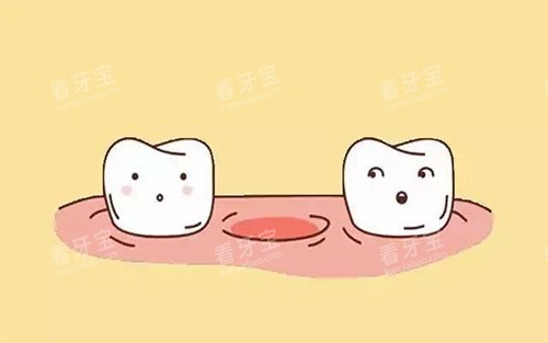 缺牙示意图.jpg 缺牙示意图.jpg