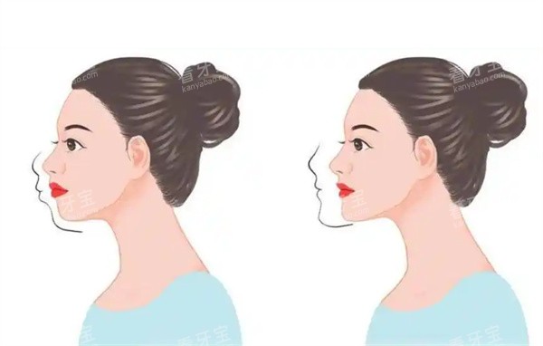 正颌矫正前后对比图.jpg 正颌矫正前后对比图.jpg