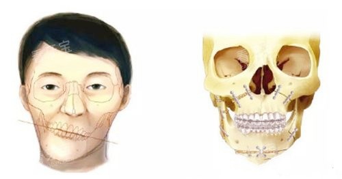 正颌手术对比图.jpg 正颌手术对比图.jpg