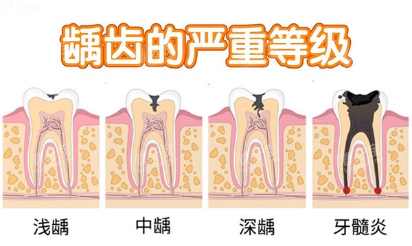 坏牙的程度.jpg 坏牙的程度.jpg