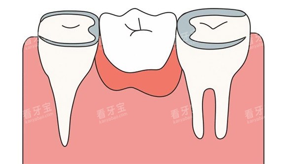 缺牙补牙照片.jpg 缺牙补牙照片.jpg