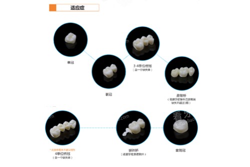 氧化锆云瓷ST牙冠适应症图.jpg 氧化锆云瓷ST牙冠适应症图.jpg