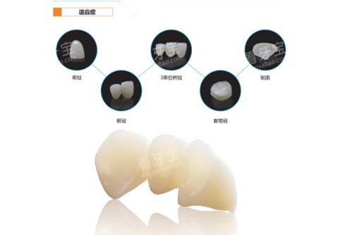 氧化锆玉瓷TT牙冠适应症图.jpg 氧化锆玉瓷TT牙冠适应症图.jpg
