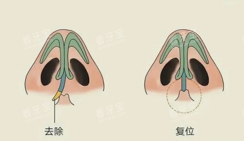 歪鼻修复矫正.jpg 歪鼻修复矫正.jpg
