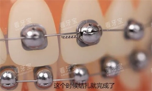 球面自锁托槽矫正近距离.jpg 球面自锁托槽矫正近距离.jpg