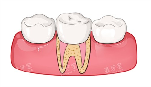 戴牙冠卡通图.jpg 戴牙冠卡通图.jpg