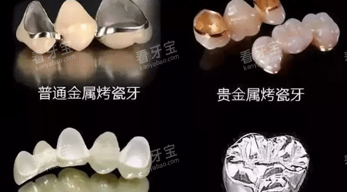 不同材质的牙冠照片.png 不同材质的牙冠照片.png
